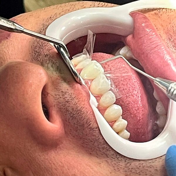 Aplicando-Facetas-de-Resina-3-MM-Clinica-Odontologica.jpg