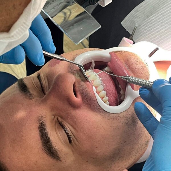 Aplicando-Facetas-de-Resina-4-MM-Clinica-Odontologica.jpg